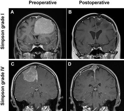 Symptom burden and <mark class="highlighted">surgical outcome</mark> in non-skull base meningiomas